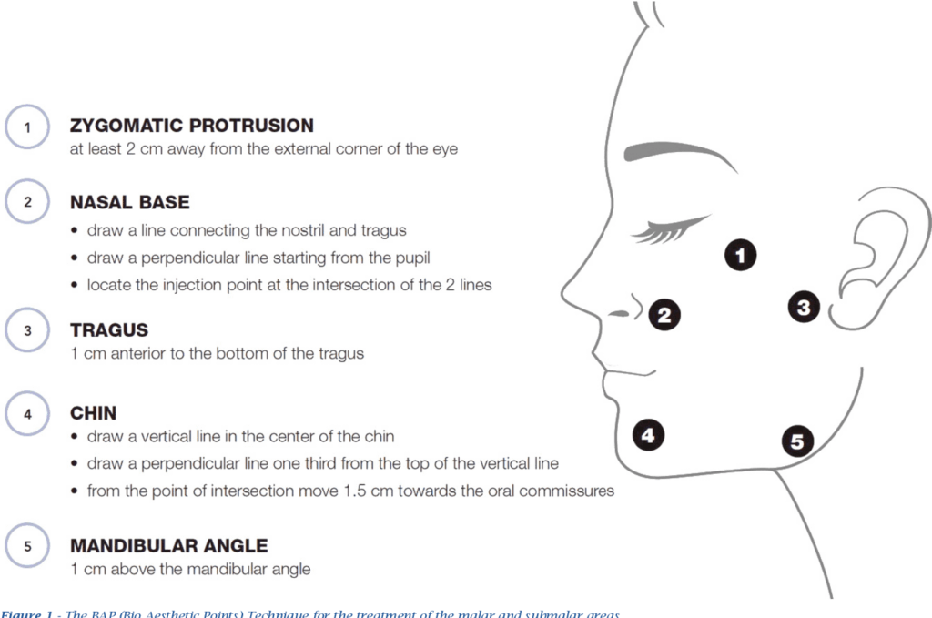 Italian Hydro-Lift HA Skinbooster is administered through five precise injection points on the face. Source Aesthetic Medicine