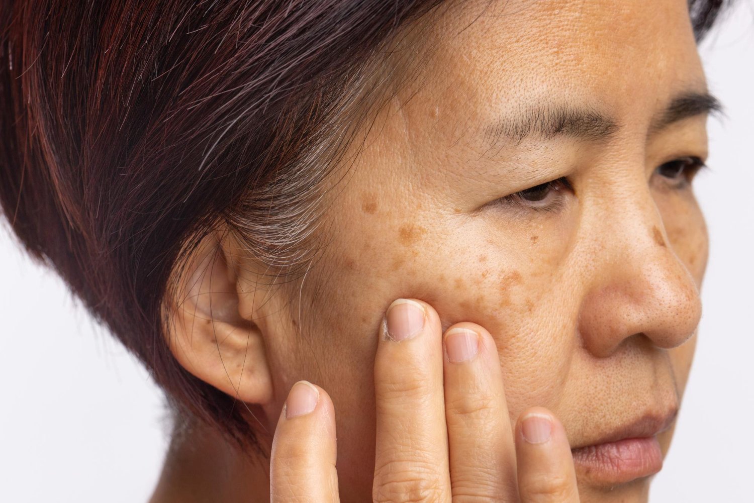 Woman with pigmentation and uneven skin tone on her cheek