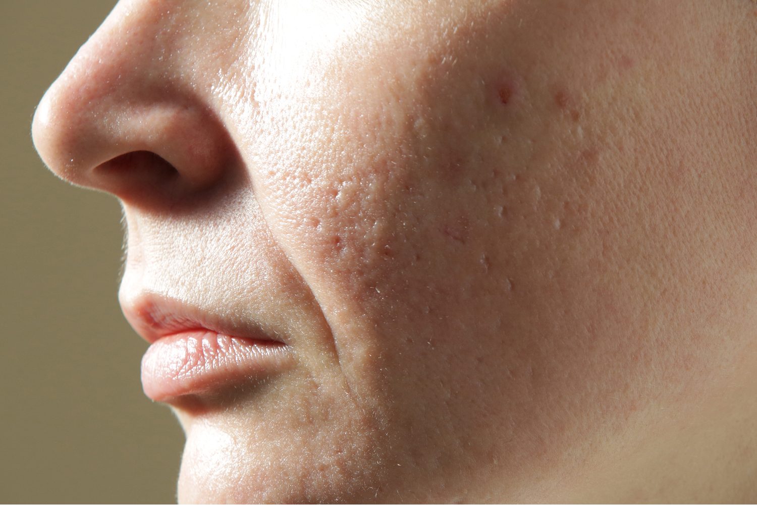 Close-up of atrophic acne scars and uneven skin texture on the cheek